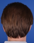 After Hair Transplant&nbsp;2 Sessions (Areas)